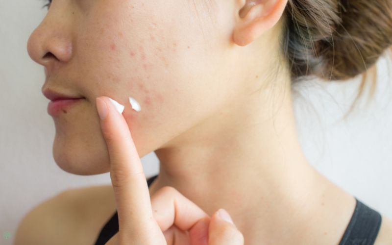 Tips acne verzorging